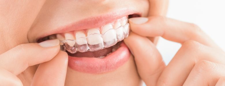 Invisalign Treatment