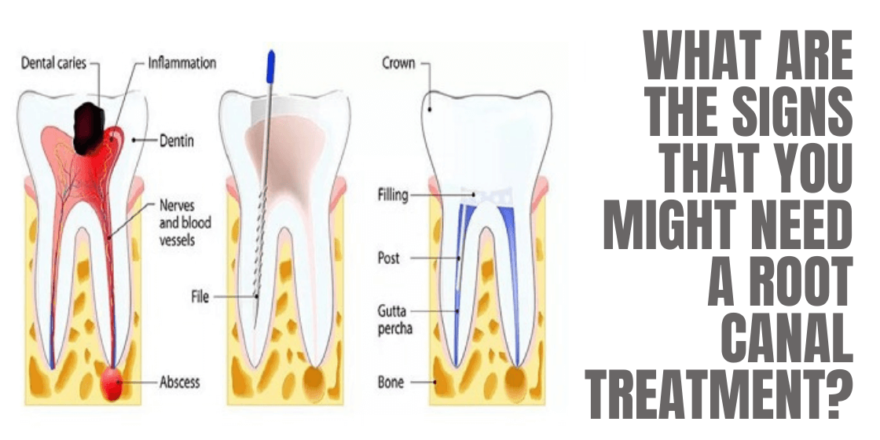 What Are the Signs That You Might Need a Root Canal Treatment