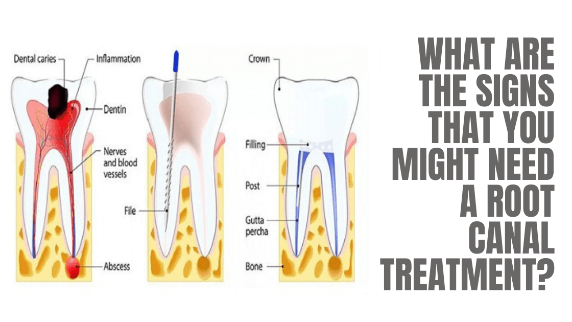 What Are the Signs That You Might Need a Root Canal Treatment