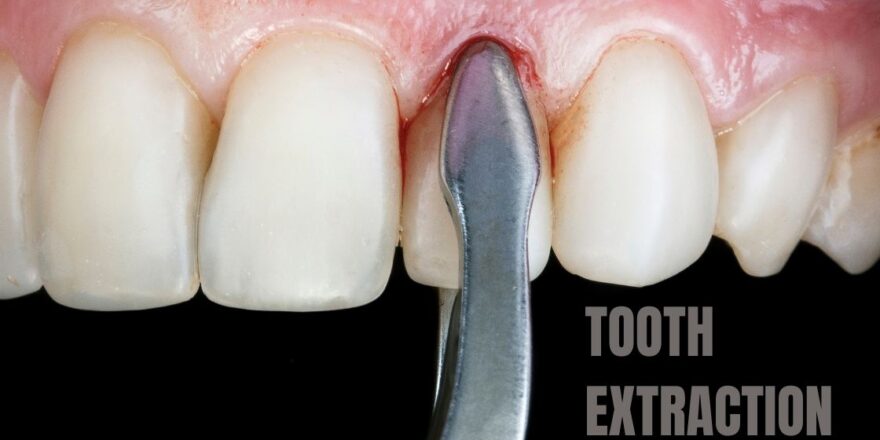 Understanding Tooth Extraction Everything You Need to Know