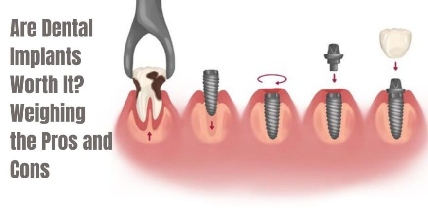 Are Dental Implants Worth It Weighing the Pros and Cons