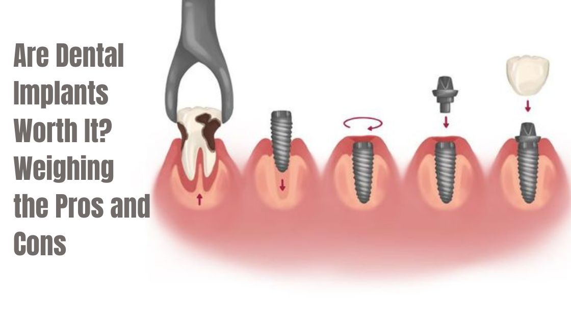 Are Dental Implants Worth It Weighing the Pros and Cons