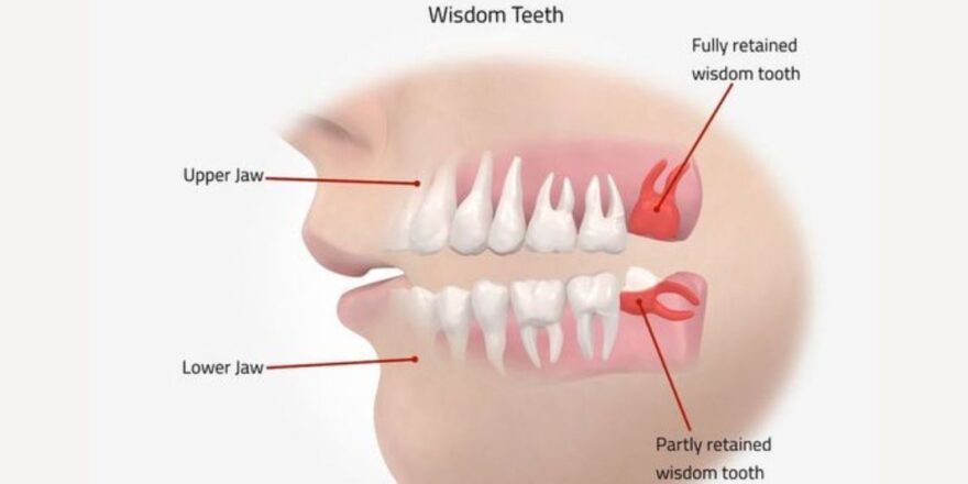 Is It Necessary to Extract Wisdom Teeth