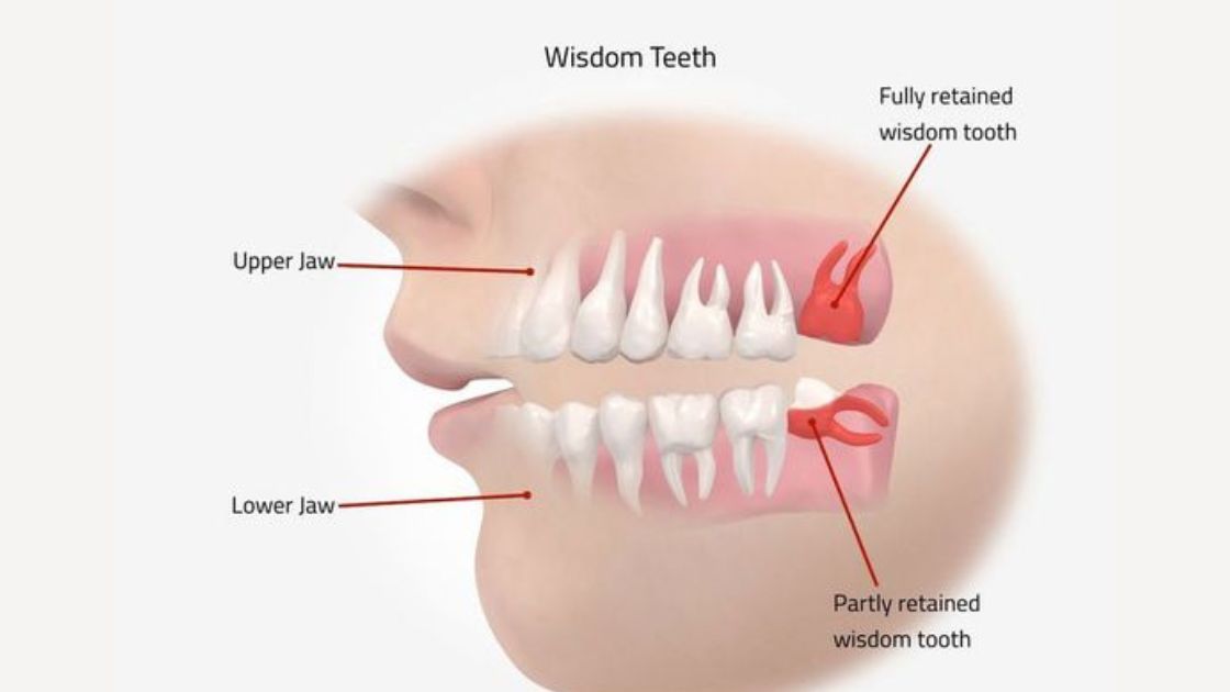 Is It Necessary to Extract Wisdom Teeth