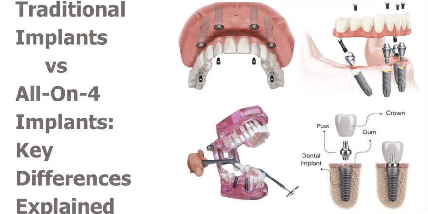 Traditional Implants vs. All-On-4 Implants: Key Differences Explained