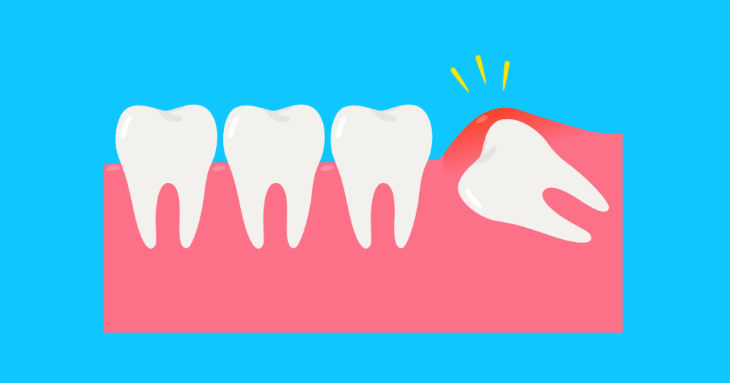 wisdom tooth Gravity Dental Polyclinic Dubai