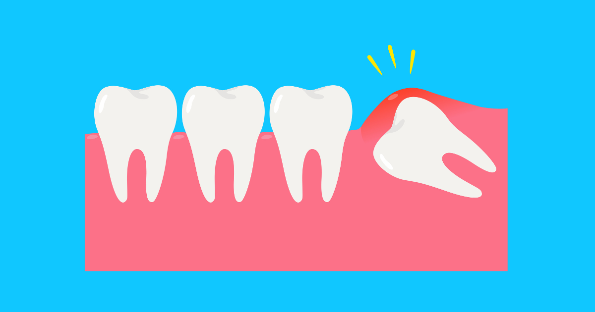 wisdom tooth Gravity Dental Polyclinic Dubai