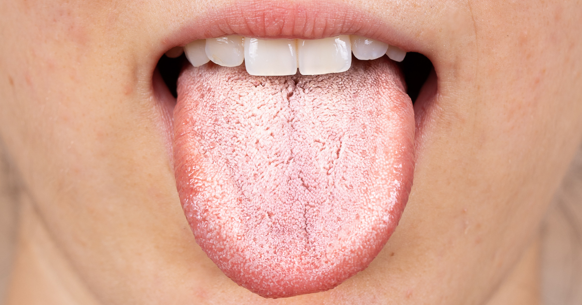 Person experiencing dry mouth while sleeping – Gravity Dental Dubai