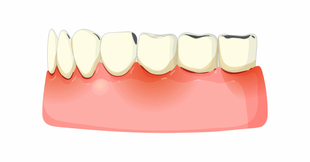 Close-up of teeth showing plaque and tartar before dental cleaning