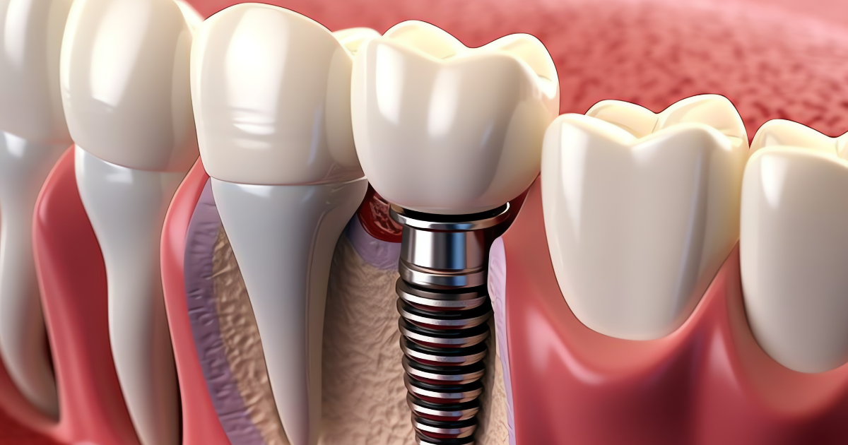 Close-up of a dental implant model showing artificial tooth and titanium root