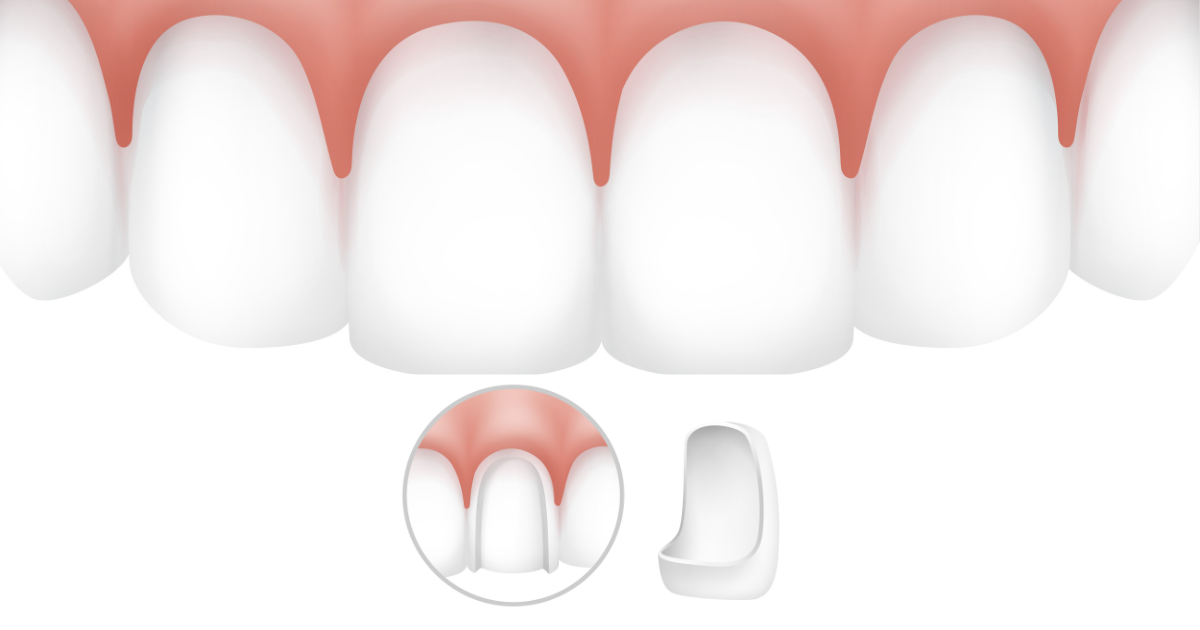 Close-up comparison of dental veneers and dental implant models Close-up comparison of dental veneers and dental implant models Gravity Dental