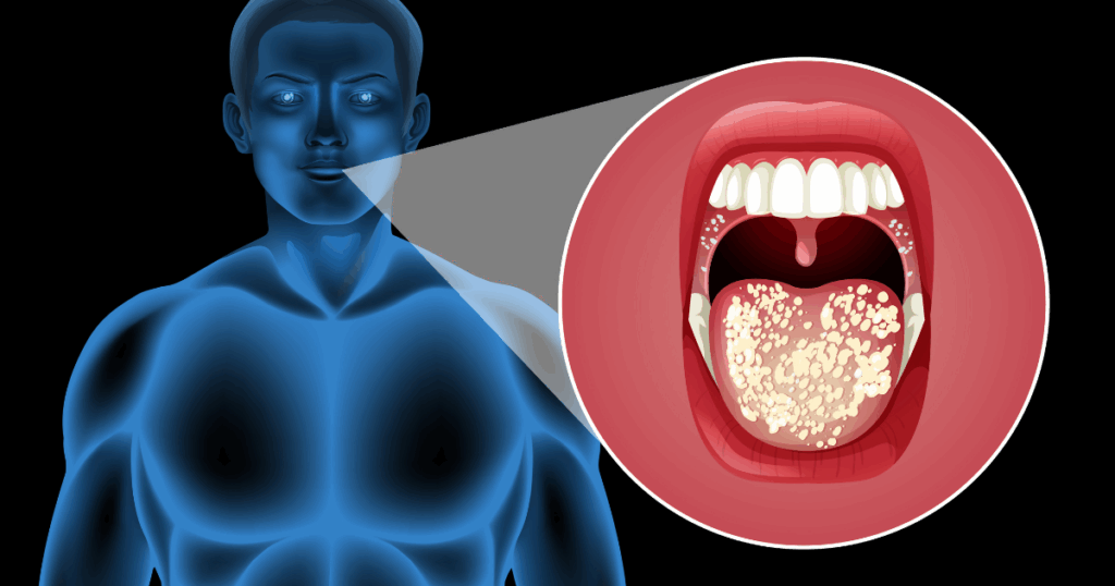 mouth cancer body model amd mouth infected mouth cancer