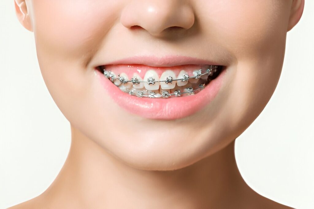 Patient with clear braces smiling at Gravity Dental Clinic Dubai