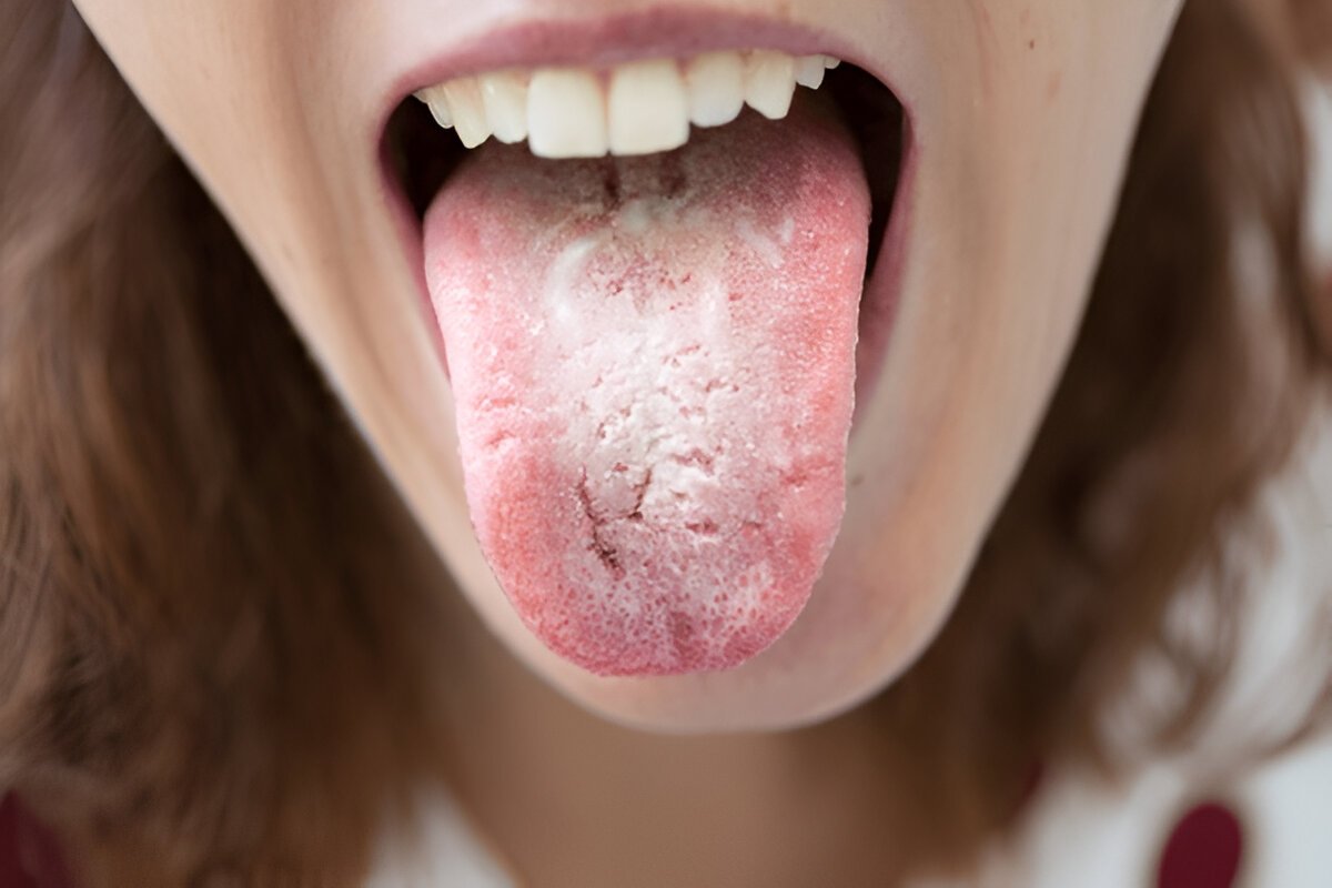 Recognizing and treating oral thrush early for better oral health
