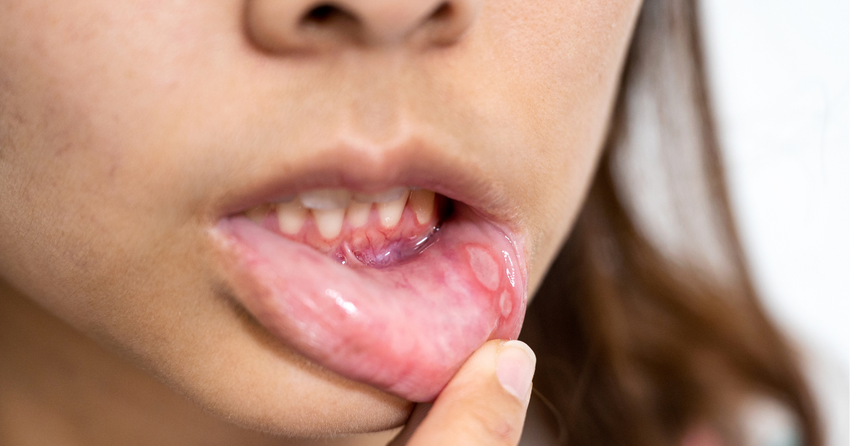 Close-up of a person with a painful canker sore inside the mouth