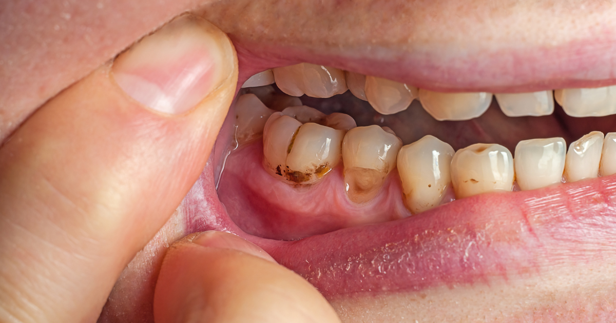 Close-up of teeth showing early signs of dental erosion with enamel wear