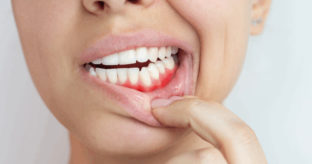 Close-up of healthy gums and teeth showing prevention of gum recession
