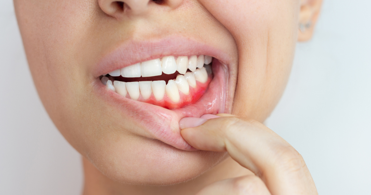Close-up of healthy gums and teeth showing prevention of gum recession
