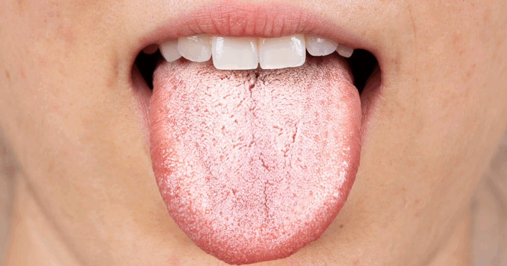 Close-up of a tongue with a white coating showing signs of poor oral hygiene