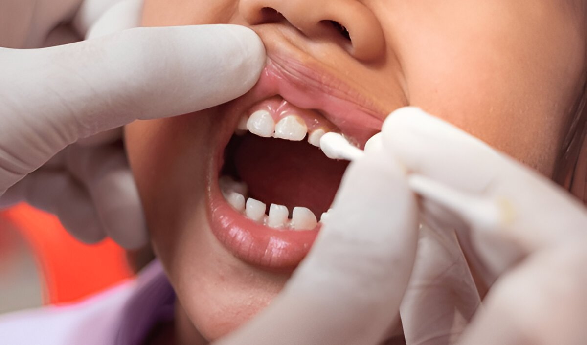 Dentist applying fluoride treatment to a child’s teeth