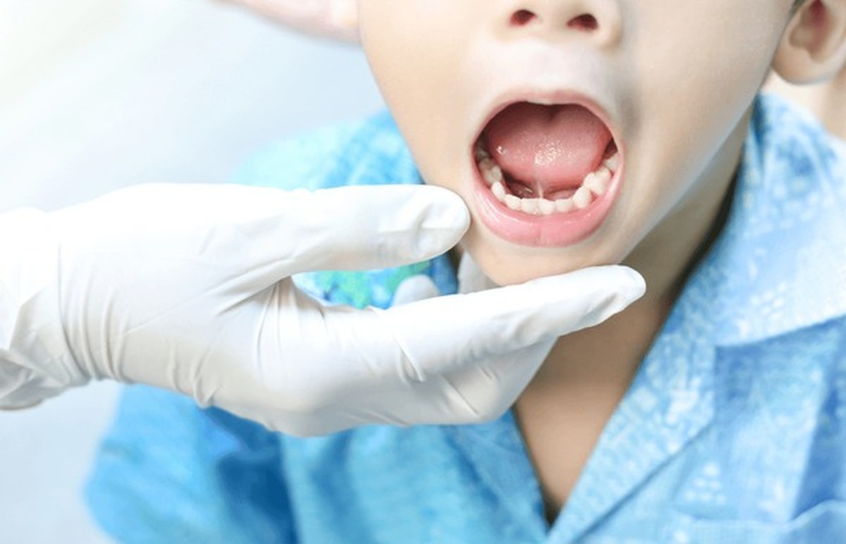 Tongue-tie symptoms and treatment options for children at Gravity Dental Dubai