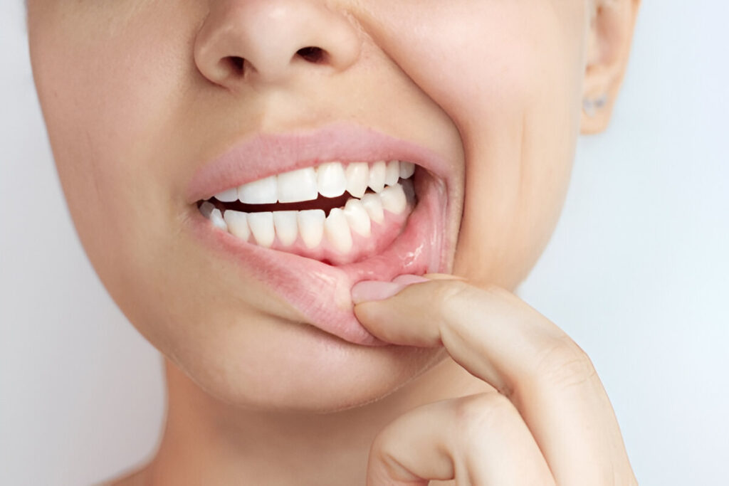Vitamin C and collagen benefits for gum health explained by Gravity Dental Polyclinic.
