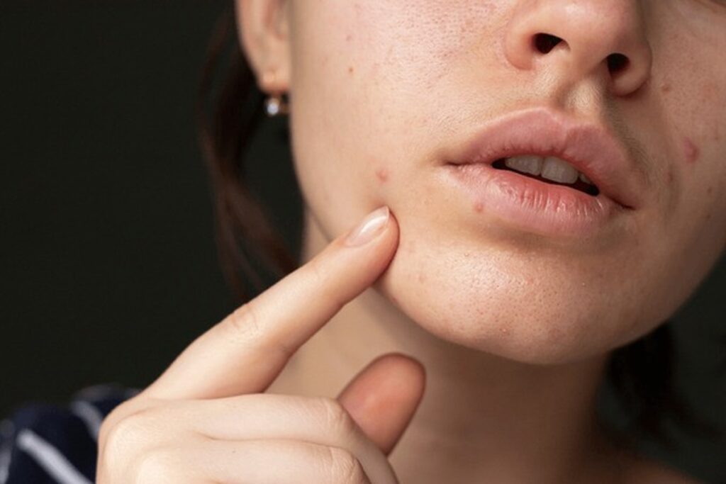 How oral hygiene influences hormonal acne and improves skin health – Gravity Dental Poly Clinic Dubai